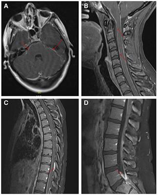 Case Report: Candida dubliniensis as a Cause of Chronic Meningitis